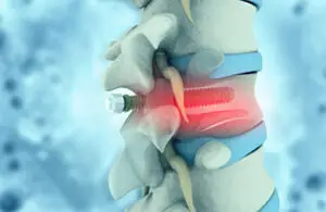 Spinal Surgery
