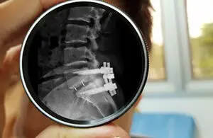 Spinal Surgery