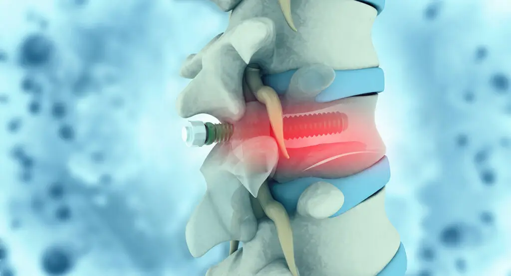 Part 2 – Spinal Surgery : Acute and Late Stage Physiotherapy