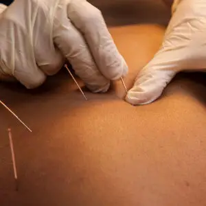 Dry Needling Course
