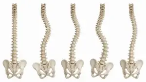 Learn Your Curves: Turning Scoliosis Assessment into Clinical Decision-Making