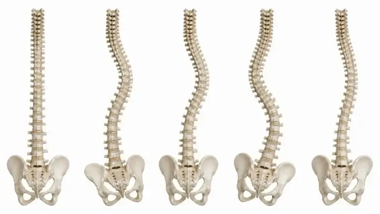Scoliosis Part 2 2026