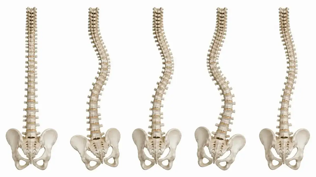 Learn Your Curves: Turning Scoliosis Assessment into Clinical Decision-Making